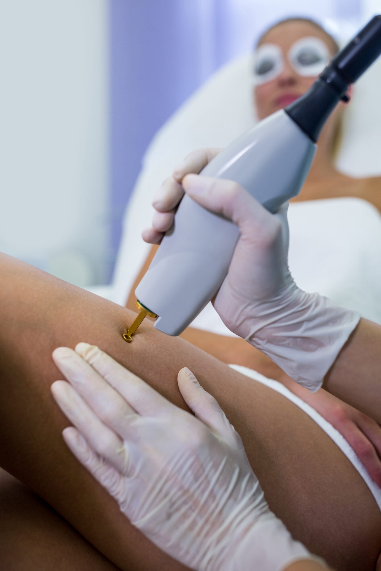 Trattamento di epilazione laser a diodo sulla gamba in centro estetico a Varese